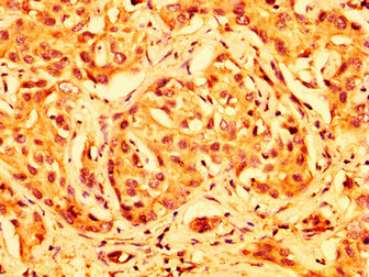 IHC image of ABCG5 Antibody diluted at 1:500 and staining in paraffin-embedded human liver cancer performed on a Leica BondTM system. After dewaxing and hydration, antigen retrieval was mediated by high pressure in a citrate buffer (pH 6.0). Section was blocked with 10% normal goat serum 30min at RT. Then primary antibody (1% BSA) was incubated at 4°C overnight. The primary is detected by a biotinylated secondary antibody and visualized using an HRP conjugated SP system.