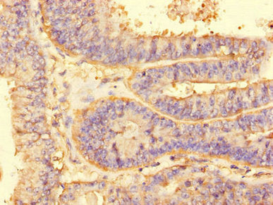 Immunohistochemistry of paraffin-embedded human endometrial cancer using the antibody at dilution of 1:100Rabbit anti-Human ALG2 Polyclonal Antibody
