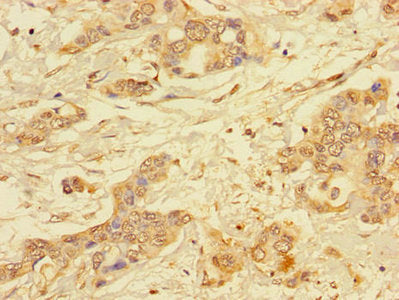 Immunohistochemistry of paraffin-embedded human pancreatic cancer using ALG2 Antibody at dilution of 1:100Rabbit anti-Human ALG2 Polyclonal Antibody