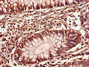 Immunohistochemistry of paraffin-embedded human colon cancer using CIAO3 Antibody at dilution of 1:100Rabbit anti-Human CIAO3 Polyclonal Antibody