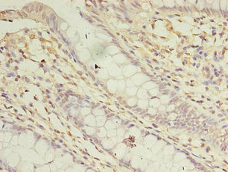 Immunohistochemistry of paraffin-embedded human colon cancer using ASB8 Antibody at dilution of 1:100Rabbit anti-Human ASB8 Polyclonal Antibody
