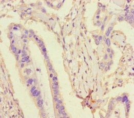 Immunohistochemistry of paraffin-embedded human pancreatic cancer using TDRD3 Antibody at dilution of 1:100Rabbit anti-Human TDRD3 Polyclonal Antibody