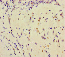 Immunohistochemistry of paraffin-embedded human lung cancer using TDRD3 Antibody at dilution of 1:100Rabbit anti-Human TDRD3 Polyclonal Antibody