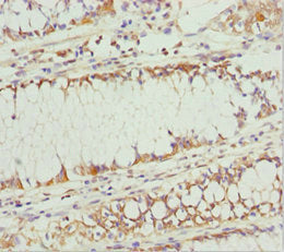 Immunohistochemistry of paraffin-embedded human colon cancer using PLEKHA1 Antibody at dilution of 1:100Rabbit anti-Human PLEKHA1 Polyclonal Antibody