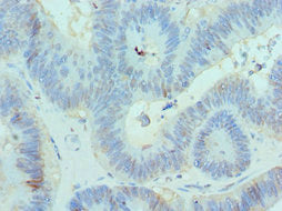 Immunohistochemistry of paraffin-embedded human colon cancer using CBX8 Antibody at dilution of 1:100