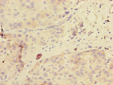 Immunohistochemistry of paraffin-embedded human liver cancer using GDPD2 Antibody at dilution of 1:100Rabbit anti-Human GDPD2 Polyclonal Antibody