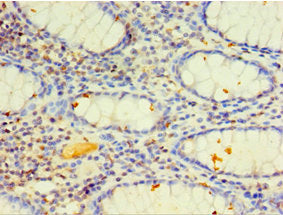 Immunohistochemistry of paraffin-embedded human colon cancer using CYP4F12 Antibody at dilution of 1:100Rabbit anti-Human CYP4F12 Polyclonal Antibody
