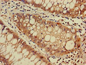 Immunohistochemistry of paraffin-embedded human colon cancer using DNAJC4 Antibody at dilution of 1:100Rabbit anti-Human DNAJC4 Polyclonal Antibody