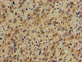 Immunohistochemistry of paraffin-embedded human glioma using the antibody at dilution of 1:100Rabbit anti-Human PLCB1 Polyclonal Antibody