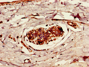 Immunohistochemistry of paraffin-embedded human breast cancer using the antibody at dilution of 1:100