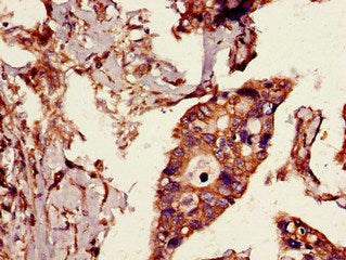 Immunohistochemistry of paraffin-embedded human pancreatic cancer using CYLD Antibody at dilution of 1:100