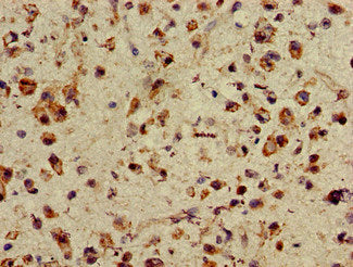 Immunohistochemistry of paraffin-embedded human glioma using the antibody at dilution of 1:100