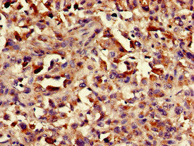 Immunohistochemistry of paraffin-embedded human melanoma using ASH1L Antibody at dilution of 1:100Rabbit anti-Human ASH1L Polyclonal Antibody