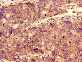 Immunocytochemistry analysis of human gastric cancer using CTPS2 Antibody at dilution of 1:100Rabbit anti-Human CTPS2 Polyclonal Antibody