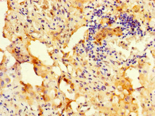 Immunohistochemistry of paraffin-embedded human lung cancer using RBM12 Antibody at dilution of 1:100Rabbit anti-Human RBM12 Polyclonal Antibody