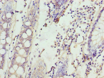 Immunohistochemistry of paraffin-embedded human colon cancer using SPTLC3 Antibody at dilution of 1:100Rabbit anti-Human SPTLC3 Polyclonal Antibody