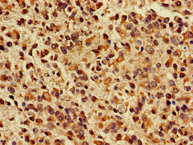 Immunohistochemistry of paraffin-embedded human glioma using the antibody at dilution of 1:100