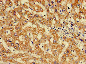 Immunohistochemistry of paraffin-embedded human liver cancer using KIF17 Antibody at dilution of 1:100