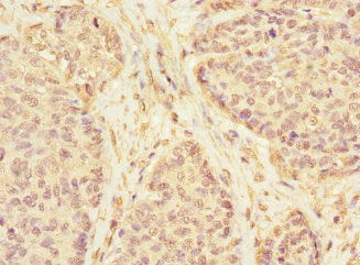 Immunohistochemistry of paraffin-embedded human ovarian cancer using KLHL13 Antibody at dilution of 1:100