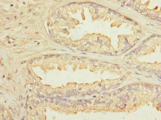 Immunohistochemistry of paraffin-embedded human prostate cancer using KLHL13 Antibody at dilution of 1:100