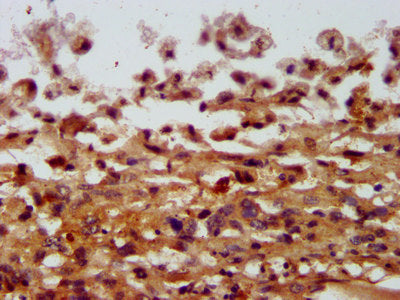 IHC image of COPG2 Antibody diluted at 1:400 and staining in paraffin-embedded human melanoma performed on a Leica BondTM system. After dewaxing and hydration, antigen retrieval was mediated by high pressure in a citrate buffer (pH 6.0). Section was blocked with 10% normal goat serum 30min at RT. Then primary antibody (1% BSA) was incubated at 4°C overnight. The primary is detected by a biotinylated secondary antibody and visualized using an HRP conjugated SP system.Rabbit anti-Human COPG2 Polyclonal Antibody
