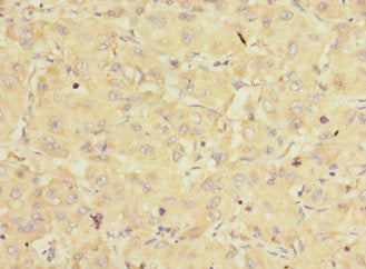 Immunohistochemistry of paraffin-embedded human liver cancer using EIF3K Antibody at dilution of 1:100Rabbit anti-Human EIF3K Polyclonal Antibody