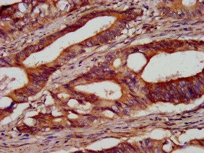IHC image of the antibody diluted at 1:100 and staining in paraffin-embedded human colon cancer performed on a Leica BondTM system. After dewaxing and hydration, antigen retrieval was mediated by high pressure in a citrate buffer (pH 6.0). Section was blocked with 10% normal goat serum 30min at RT. Then primary antibody (1% BSA) was incubated at 4°C overnight. The primary is detected by a biotinylated secondary antibody and visualized using an HRP conjugated SP system.