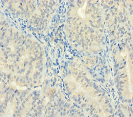 Immunohistochemistry of paraffin-embedded human endometrial cancer using ZMAT5 Antibody at dilution of 1:100Rabbit anti-Human ZMAT5 Polyclonal Antibody