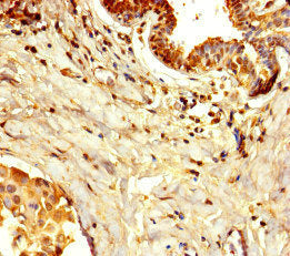 Immunohistochemistry of paraffin-embedded human breast cancer using the antibody at dilution of 1:100Rabbit anti-Human DPH7 Polyclonal Antibody