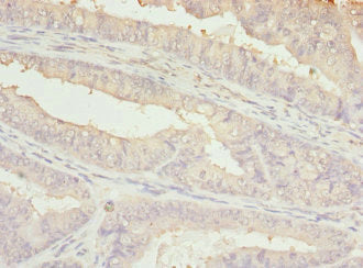 Immunohistochemistry of paraffin-embedded human endometrial cancer using BBS2 Antibody at dilution of 1:100