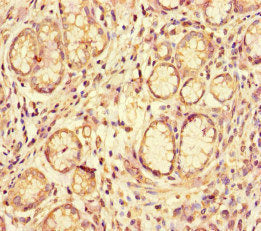 Immunohistochemistry of paraffin-embedded human gastric cancer using the antibody at dilution of 1:100