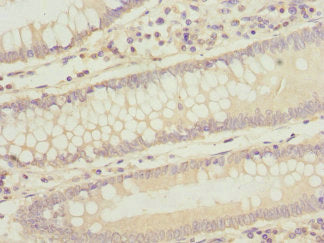 Immunohistochemistry of paraffin-embedded human colon cancer using ASPSCR1 Antibody at dilution of 1:100Rabbit anti-Human ASPSCR1 Polyclonal Antibody