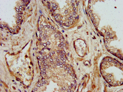 IHC image of SHARPIN Antibody diluted at 1:500 and staining in paraffin-embedded human prostate cancer performed on a Leica BondTM system. After dewaxing and hydration, antigen retrieval was mediated by high pressure in a citrate buffer (pH 6.0). Section was blocked with 10% normal goat serum 30min at RT. Then primary antibody (1% BSA) was incubated at 4°C overnight. The primary is detected by a biotinylated secondary antibody and visualized using an HRP conjugated SP system.Rabbit anti-Human SHARPIN Polyclonal Antibody