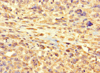 Immunohistochemistry of paraffin-embedded human melanoma using RSPH9 Antibody at dilution of 1:100Rabbit anti-Human RSPH9 Polyclonal Antibody