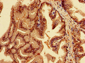 Immunohistochemistry of paraffin-embedded human prostate cancer using EPN3 Antibody at dilution of 1:100Rabbit anti-Human EPN3 Polyclonal Antibody