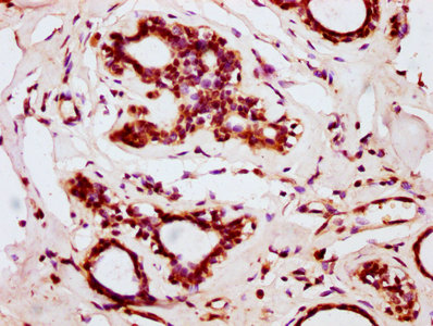 IHC image of the antibody diluted at 1:200 and staining in paraffin-embedded human breast cancer performed on a Leica BondTM system. After dewaxing and hydration, antigen retrieval was mediated by high pressure in a citrate buffer (pH 6.0). Section was blocked with 10% normal goat serum 30min at RT. Then primary antibody (1% BSA) was incubated at 4°C overnight. The primary is detected by a biotinylated secondary antibody and visualized using an HRP conjugated SP system.