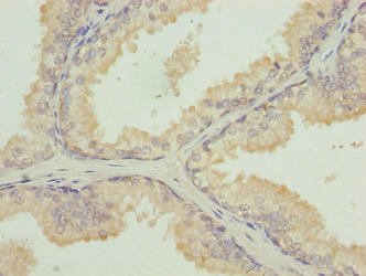 Immunohistochemistry of paraffin-embedded human prostate cancer using TUBB1 Antibody at dilution of 1:100Rabbit anti-Human TUBB1 Polyclonal Antibody