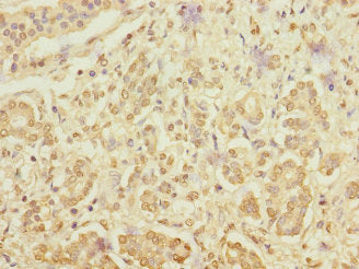 Immunohistochemistry of paraffin-embedded human pancreatic cancer using RANBP3 Antibody at dilution of 1:100Rabbit anti-Human RANBP3 Polyclonal Antibody