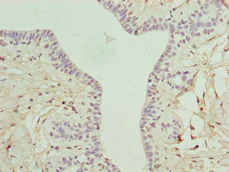 Immunohistochemistry of paraffin-embedded human breast cancer using ARMT1 Antibody at dilution of 1:100Rabbit anti-Human ARMT1 Polyclonal Antibody