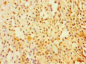 Immunohistochemistry of paraffin-embedded human breast cancer using SUGCT Antibody at dilution of 1:100Rabbit anti-Human SUGCT Polyclonal Antibody