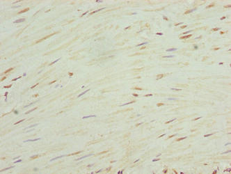 Immunohistochemistry of paraffin-embedded human colon cancer using RHOF Antibody at dilution of 1:100Rabbit anti-Human RHOF Polyclonal Antibody