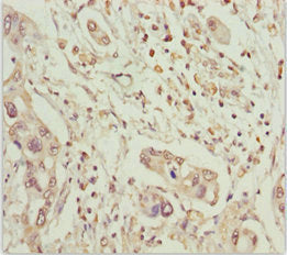 Immunohistochemistry of paraffin-embedded human pancreatic cancer using MCCC2 Antibody at dilution of 1:100