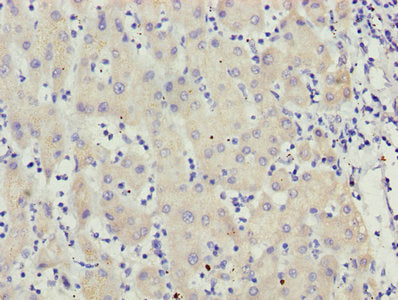 Immunohistochemistry of paraffin-embedded human liver cancer using MCCC2 Antibody at dilution of 1:100
