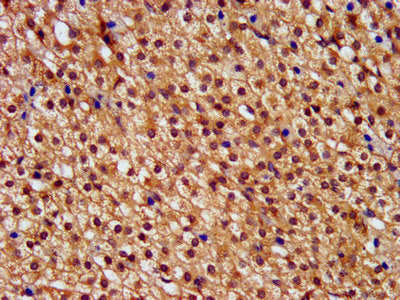 IHC image of the antibody diluted at 1:400 and staining in paraffin-embedded human adrenal gland tissue performed on a Leica BondTM system. After dewaxing and hydration, antigen retrieval was mediated by high pressure in a citrate buffer (pH 6.0). Section was blocked with 10% normal goat serum 30min at RT. Then primary antibody (1% BSA) was incubated at 4°C overnight. The primary is detected by a biotinylated secondary antibody and visualized using an HRP conjugated SP system.Rabbit anti-Human PNPLA8 Polyclonal Antibody