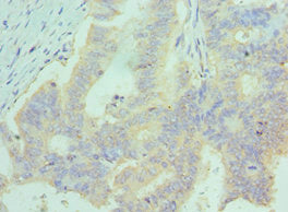 Immunohistochemistry of paraffin-embedded human colon cancer using CCL28 Antibody at dilution of 1:100 _x000C__x0001_Rabbit anti-Human CCL28 Polyclonal Antibody