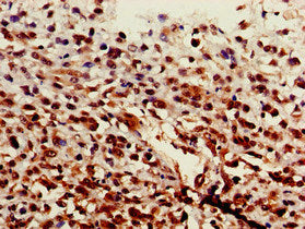 Immunohistochemistry of paraffin-embedded human melanoma using ST6GALNAC1 Antibody at dilution of 1:100Rabbit anti-Human ST6GALNAC1 Polyclonal Antibody