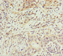 Immunohistochemistry of paraffin-embedded human bladder cancer using ABCB8 Antibody at dilution of 1:100