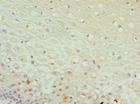 Immunohistochemistry of paraffin-embedded human cervical cancer using DPP3 Antibody at dilution of 1:100Rabbit anti-Human DPP3 Polyclonal Antibody