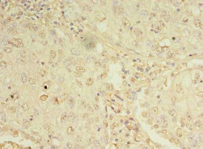 Immunohistochemistry of paraffin-embedded human lung cancer using ORMDL1 Antibody at dilution of 1:100Rabbit anti-Human ORMDL1 Polyclonal Antibody