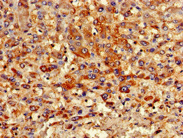 Immunohistochemistry of paraffin-embedded human liver cancer using PIPOX Antibody at dilution of 1:100Rabbit anti-Human PIPOX Polyclonal Antibody